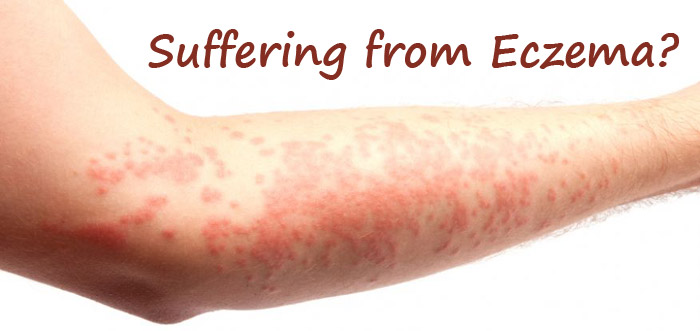 Eczema Causes Symptoms And Treatment