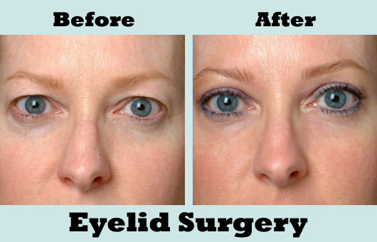 Eyelid Surgery or Blepharoplasty - Procedure, Pros & Cons