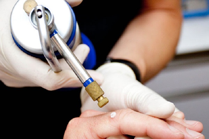 Cryotherapy for Warts - WebMD