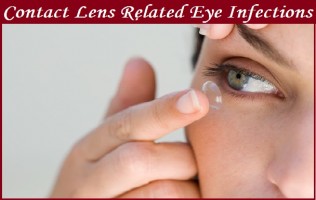 Contact Lens Related Eye Infections